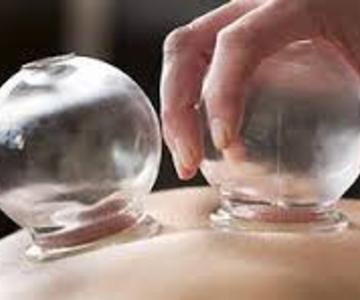 Cupping therapy