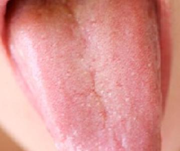Tongue Diagnosis