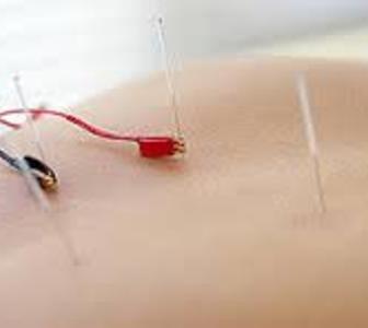Acupuncture Pain Management